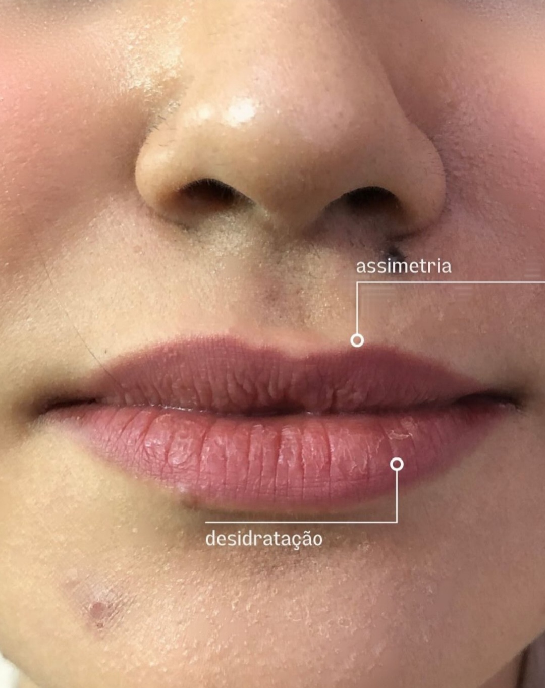 Antes do Preenchimento Labial