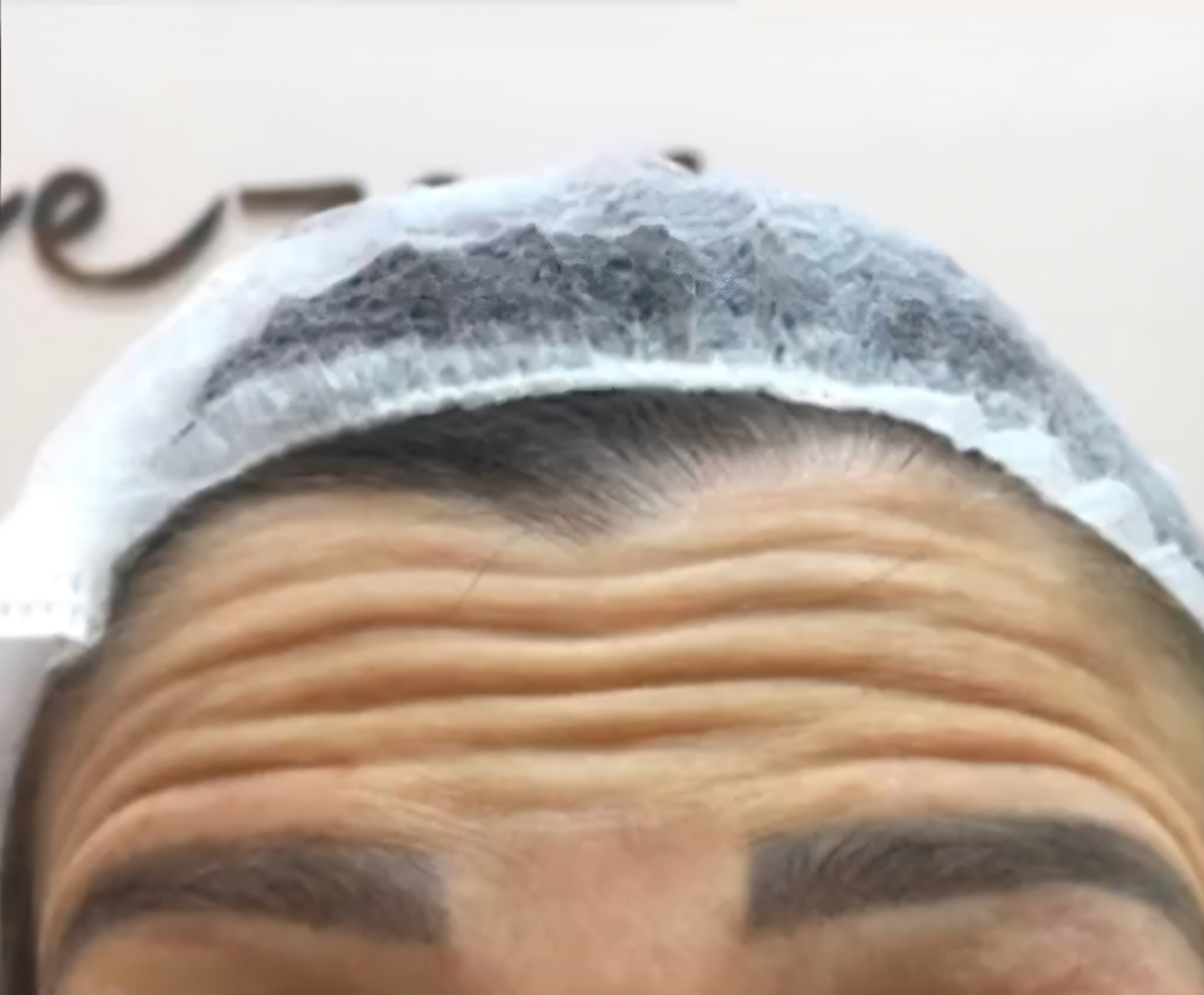 Antes do Botox